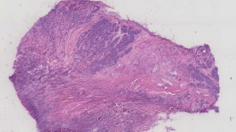 Histopathologischer Gewebeschnitt eines Patienten mit einem Kopf-Hals-Tumor, gefärbt mit Hämatoxylin und Eosin.